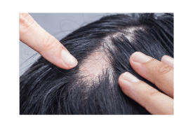 Como A Terapia Capilar Pode Tratar A Alopecia Areata Centro De Sa De